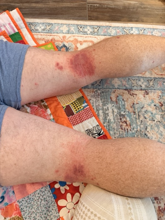 post-prednisone rash